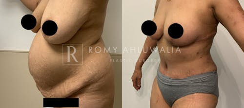 Before & After Result of Tummy Tuck Patient #1