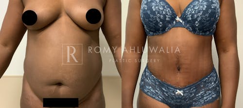 Before & After Result of Tummy Tuck Patient #54