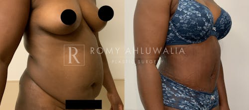 Before & After Result of Tummy Tuck Patient #54