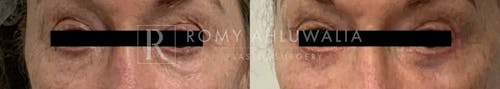 Before & After Result of Upper & Lower Eyedlid Surgery Patient #11
