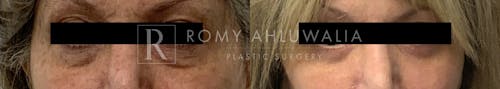 Before & After Result of Lower Eyelid Surgery Patient #12