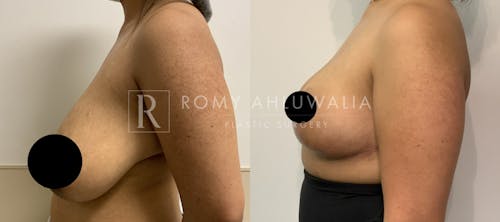 Before & After Result of Breast Reduction Patient #25