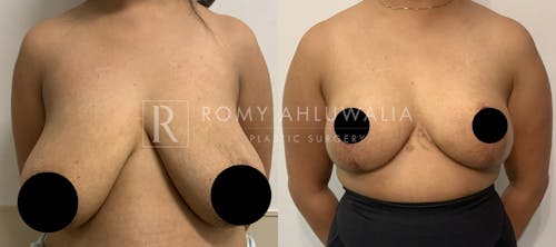 Before & After Result of Breast Reduction Patient #25