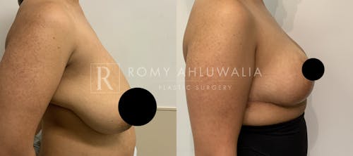 Before & After Result of Breast Reduction Patient #25