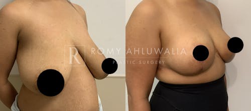 Before & After Result of Breast Reduction Patient #25