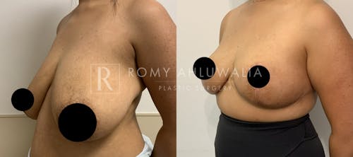 Before & After Result of Breast Reduction Patient #25