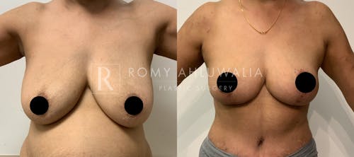 Before & After Result of Breast Reduction Patient #12