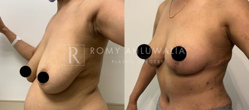 Before & After Result of Breast Reduction Patient #12