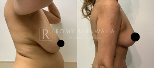 Before & After Result of Breast Reduction Patient #12