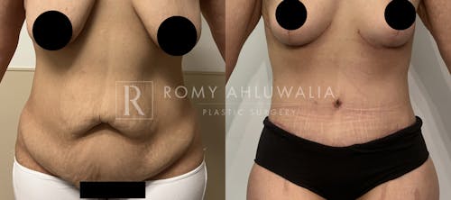 Before & After Result of Tummy Tuck Patient #55