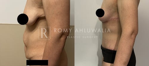 Before & After Result of Tummy Tuck Patient #55
