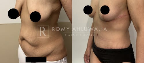 Before & After Result of Tummy Tuck Patient #55