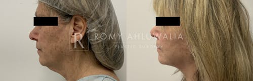 Before & After Result of Facelift Patient #16