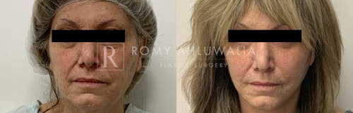 Before & After Result of Facelift Patient #16