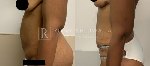 Before & After Result of Tummy Tuck Patient #56