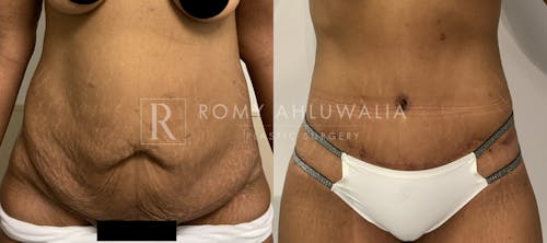 Before & After Result of Tummy Tuck Patient #56