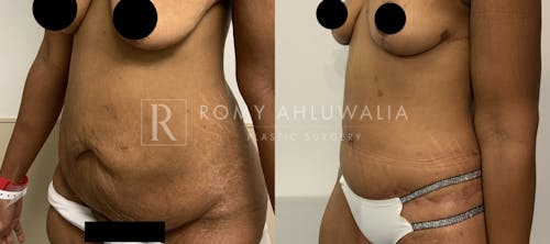 Before & After Result of Tummy Tuck Patient #56