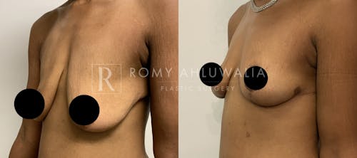 Before & After Result of Breast Reduction Patient #33