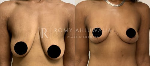 Before & After Result of Breast Reduction Patient #33