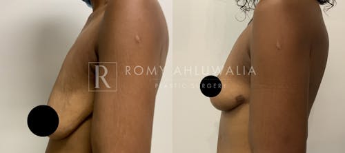 Before & After Result of Breast Reduction Patient #33