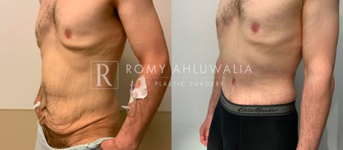 Before & After Result of Tummy Tuck Patient #63