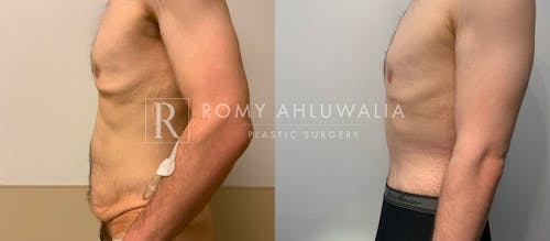 Before & After Result of Tummy Tuck Patient #63