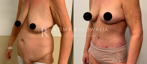 Before & After Result of Tummy Tuck Patient #57