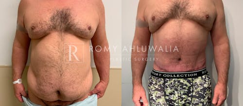 Before & After Result of Tummy Tuck Patient #64