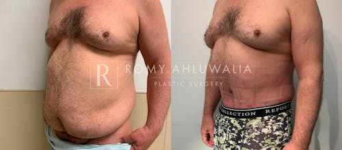 Before & After Result of Tummy Tuck Patient #64