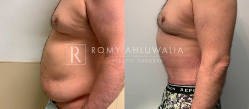 Before & After Result of Tummy Tuck Patient #64