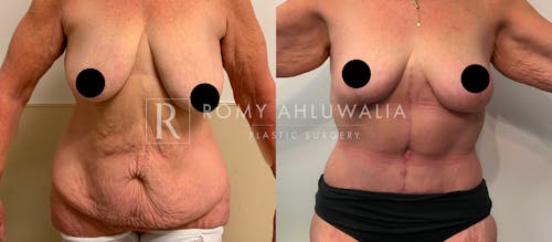 Before & After Result of Tummy Tuck Patient #62