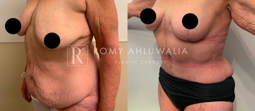 Before & After Result of Tummy Tuck Patient #62