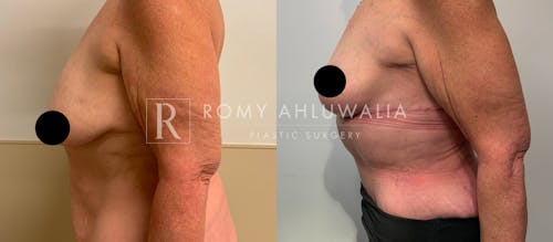 Before & After Result of Tummy Tuck Patient #62