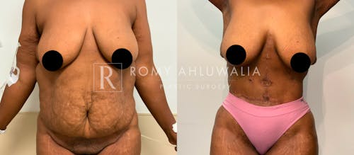 Before & After Result of Tummy Tuck Patient #60