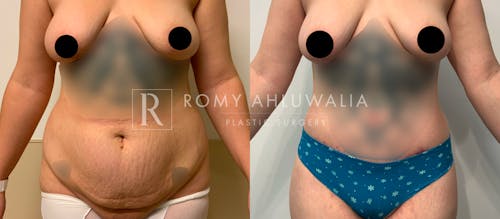 Before & After Result of Tummy Tuck Patient #58