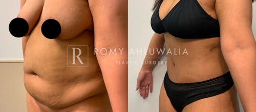 Before & After Result of Tummy Tuck Patient #59