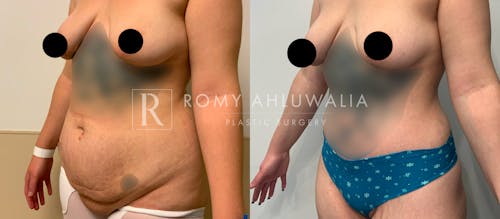 Before & After Result of Tummy Tuck Patient #58