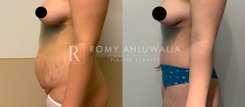 Before & After Result of Tummy Tuck Patient #58