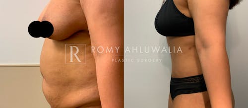 Before & After Result of Tummy Tuck Patient #59