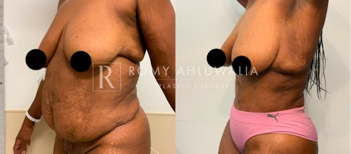 Before & After Result of Tummy Tuck Patient #60