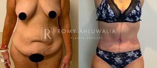 Before & After Result of Tummy Tuck Patient #61