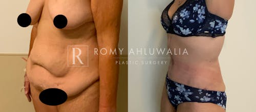 Before & After Result of Tummy Tuck Patient #61