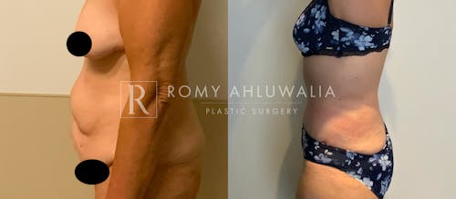 Before & After Result of Tummy Tuck Patient #61