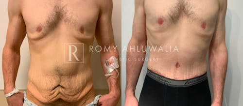 Before & After Result of Tummy Tuck Patient #63