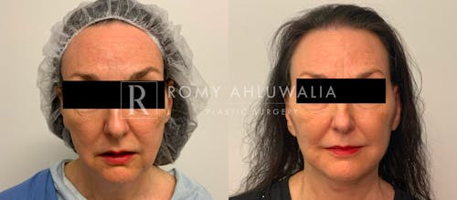 Before & After Result of Facelift Patient #17