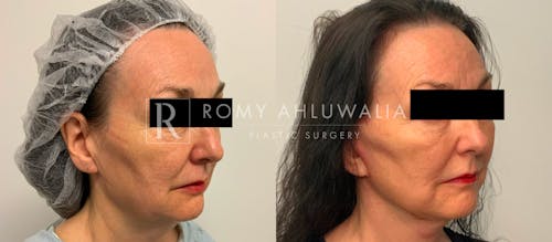 Before & After Result of Facelift Patient #17