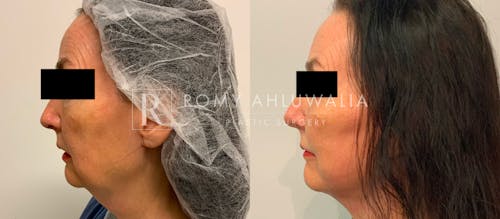 Before & After Result of Facelift Patient #17