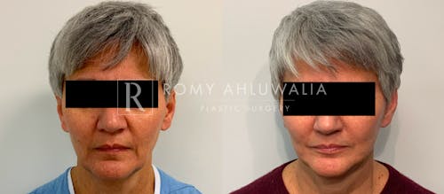 Before & After Result of Mini Facelift Patient #18