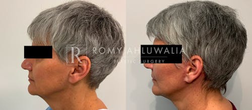 Before & After Result of Mini Facelift Patient #18