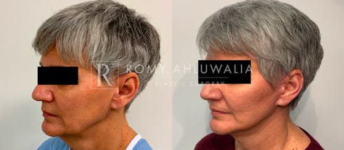 Before & After Result of Mini Facelift Patient #18